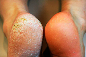 callus peel